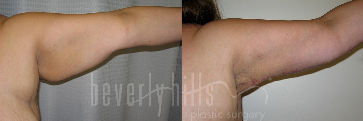 Arm Lift Patient 03 Before & After