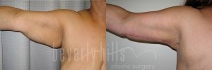 Arm Lift Patient 03 Before & After - Thumbnail