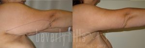 Arm Lift Patient 03 Before & After - Thumbnail