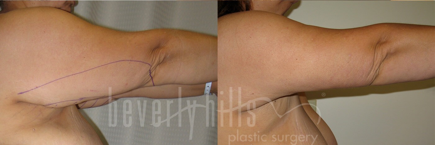 Arm Lift Patient 03 Before & After