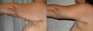 Arm Lift Patient 03 Before & After - Thumbnail