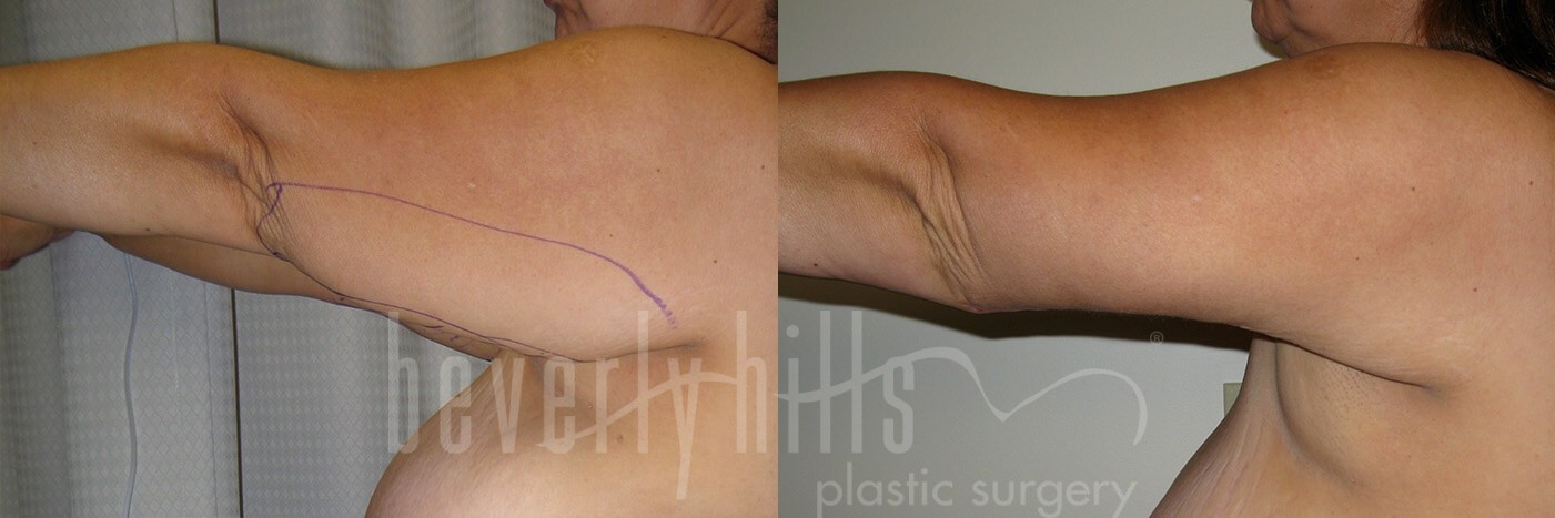 Arm Lift Patient 03 Before & After