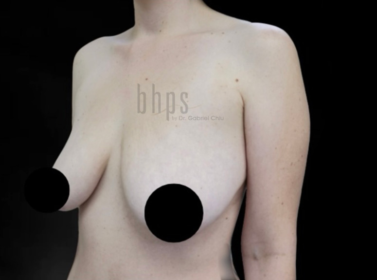 Case--8637 | Before Breast Augmentation with Lift 2