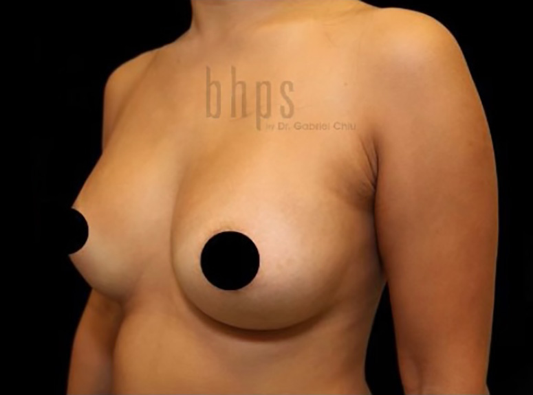 Case--6469 | After Breast Augmentation with Lift 2