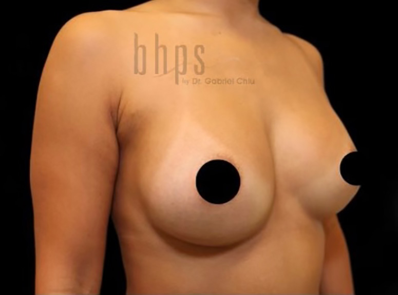 Case--6469 | After Breast Augmentation with Lift 4