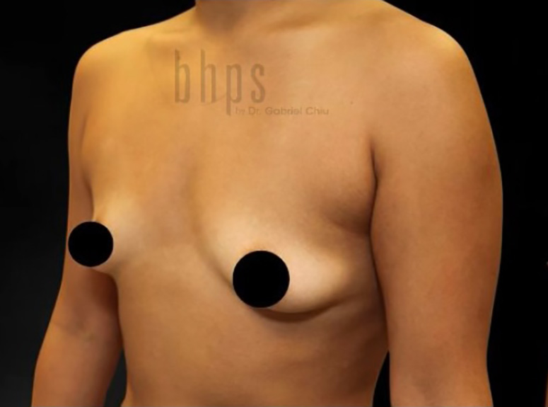 Case--6469 | Before Breast Augmentation with Lift 2
