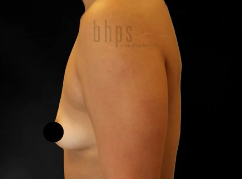 Case--6469 | Before Breast Augmentation with Lift 3