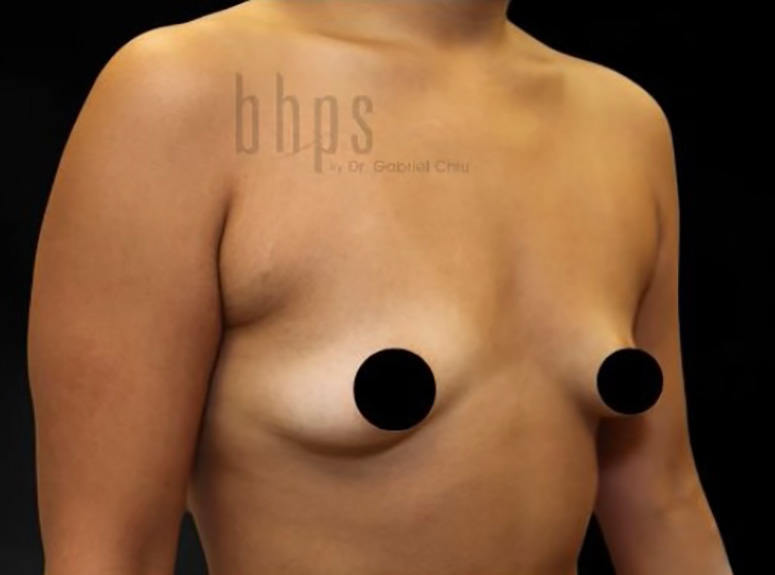Case--6469 | Before Breast Augmentation with Lift 4