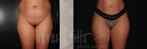Brazilian Butt Lift Patient 01 Before & After - Thumbnail