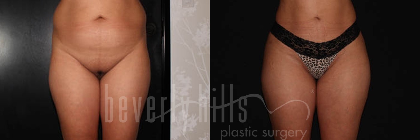 Brazilian Butt Lift Patient 01 Before & After