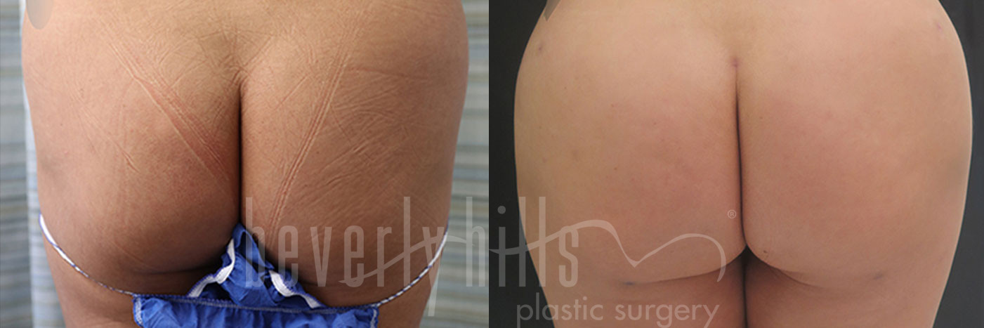Brazilian Butt Lift Patient 29 Before & After