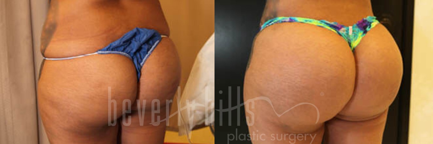 Brazilian Butt Lift Patient 02 Before & After