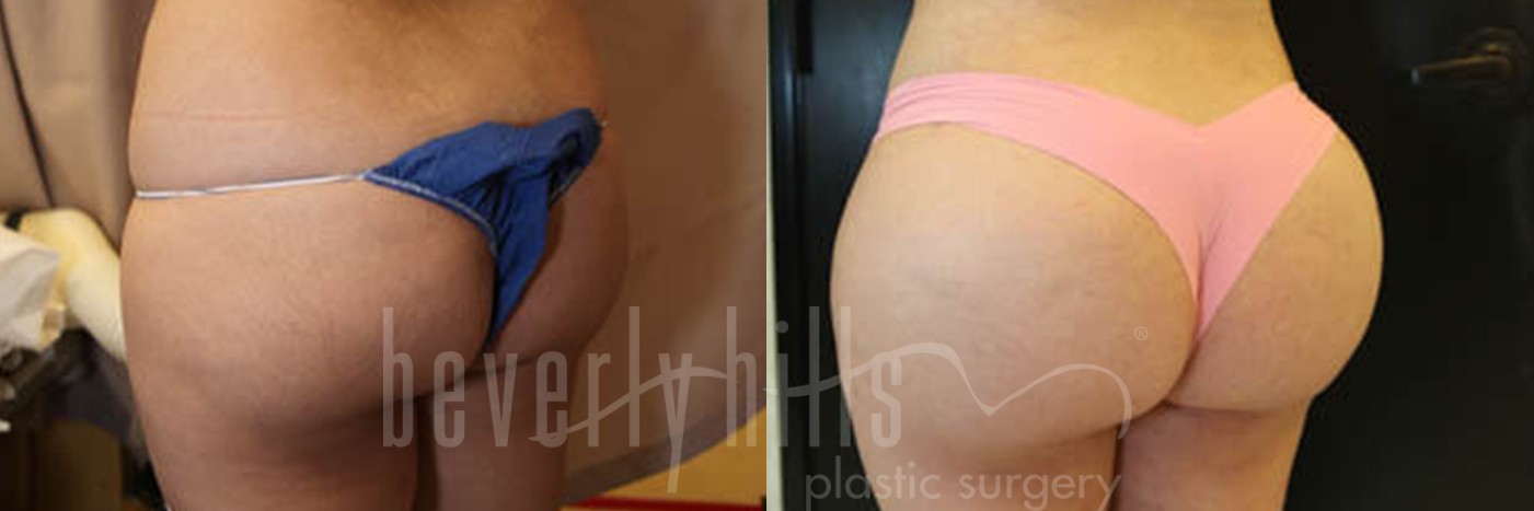 Brazilian Butt Lift Patient 03 Before & After