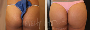 Brazilian Butt Lift Patient 04 Before & After - Thumbnail
