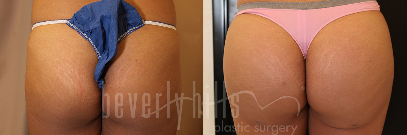 Brazilian Butt Lift Patient 04 Before & After