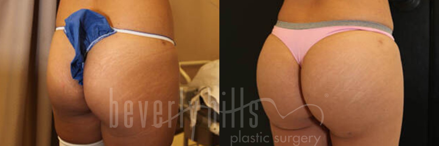 Brazilian Butt Lift Patient 04 Before & After