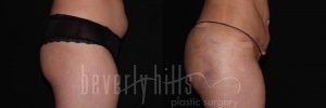 Brazilian Butt Lift Patient 06 Before & After - Thumbnail