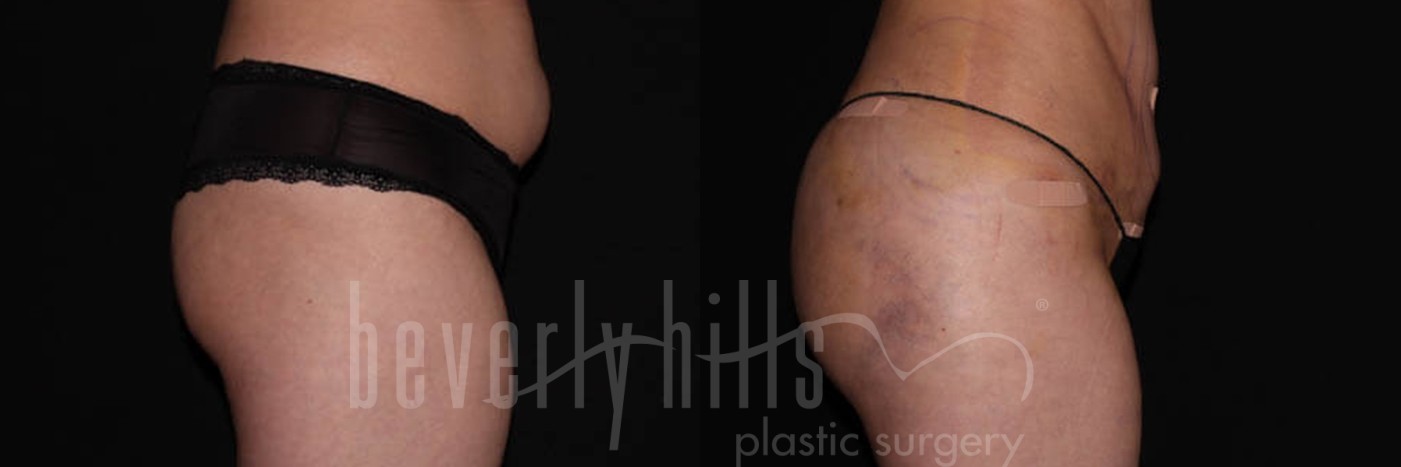 Brazilian Butt Lift Patient 06 Before & After