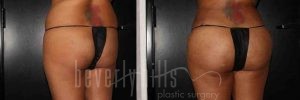 Brazilian Butt Lift Patient 07 Before & After - Thumbnail