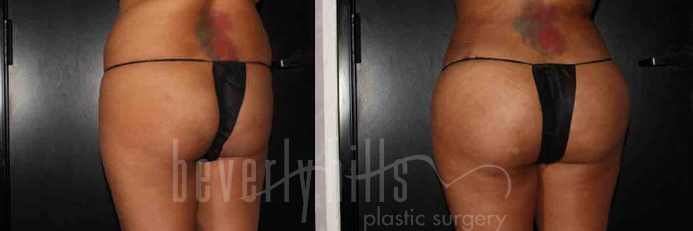 Brazilian Butt Lift Patient 07 Before & After