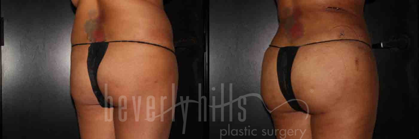 Brazilian Butt Lift Patient 07 Before & After