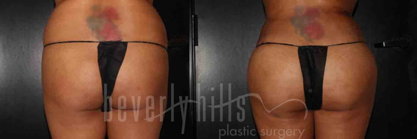 Brazilian Butt Lift Patient 07 Before & After