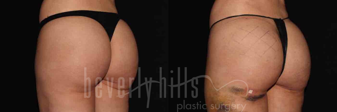 Brazilian Butt Lift Patient 08 Before & After