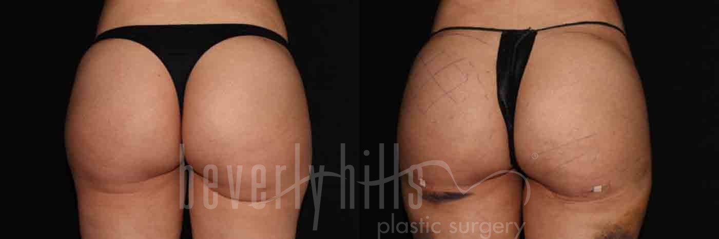 Brazilian Butt Lift Patient 08 Before & After