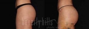 Brazilian Butt Lift Patient 08 Before & After - Thumbnail