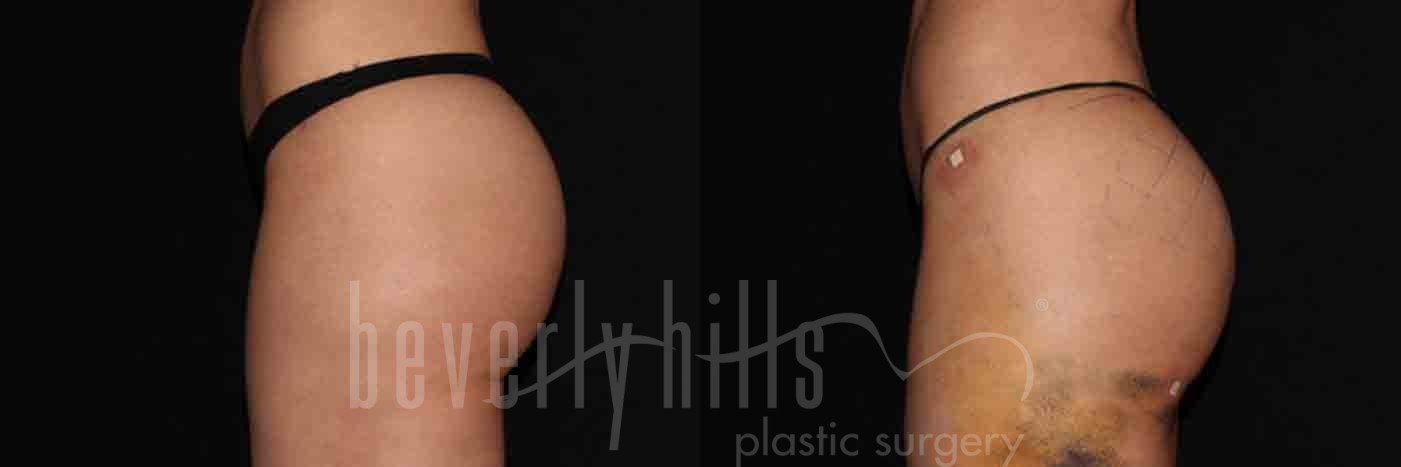Brazilian Butt Lift Patient 08 Before & After