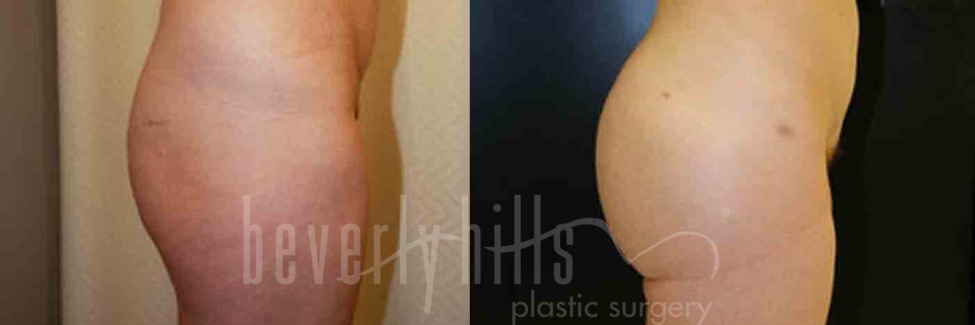 Brazilian Butt Lift Patient 09 Before & After