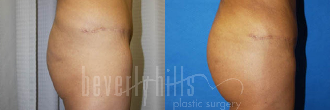 Brazilian Butt Lift Patient 10 Before & After