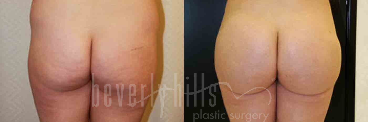 Brazilian Butt Lift Patient 12 Before & After