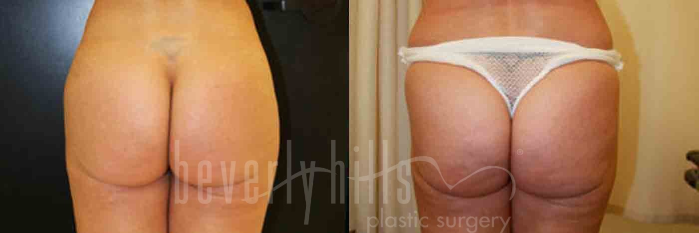 Brazilian Butt Lift Patient 13 Before & After