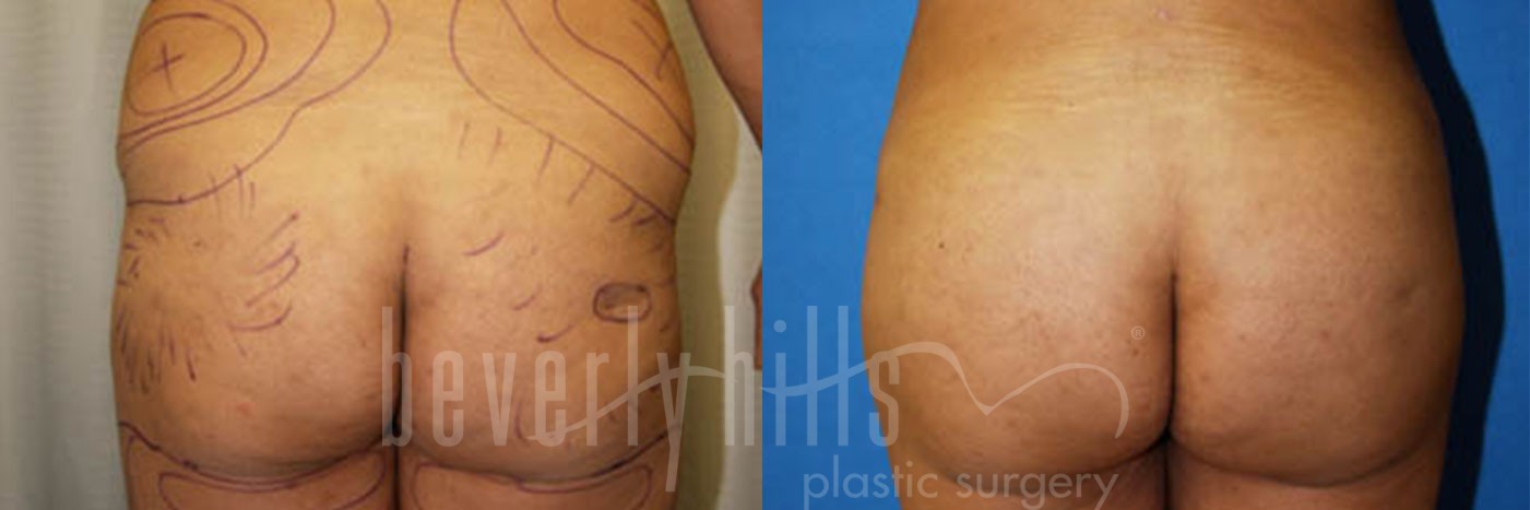 Brazilian Butt Lift Patient 14 Before & After