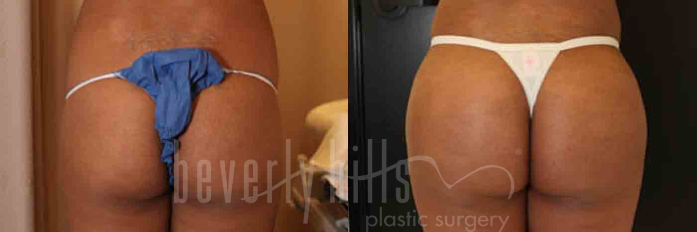 Brazilian Butt Lift Patient 15 Before & After