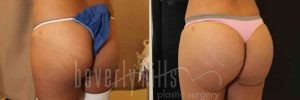 Brazilian Butt Lift Patient 04 Before & After - Thumbnail