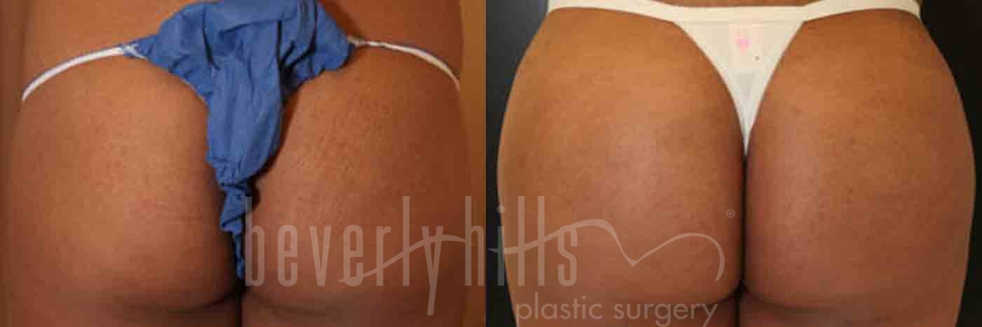 Brazilian Butt Lift Patient 15 Before & After