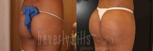 Brazilian Butt Lift Patient 15 Before & After - Thumbnail