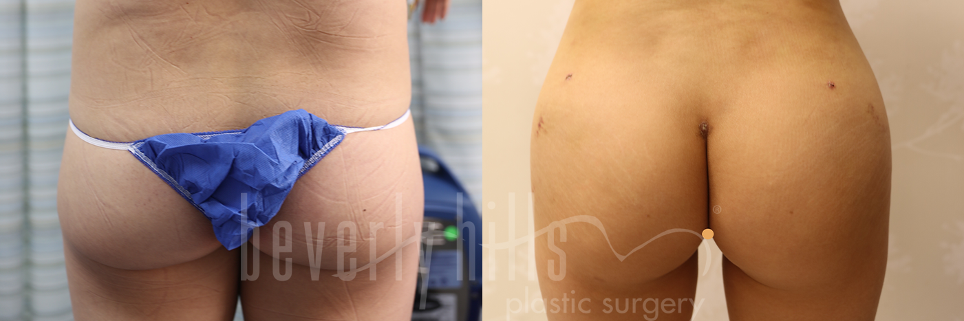 Brazilian Butt Lift Patient 17 Before & After