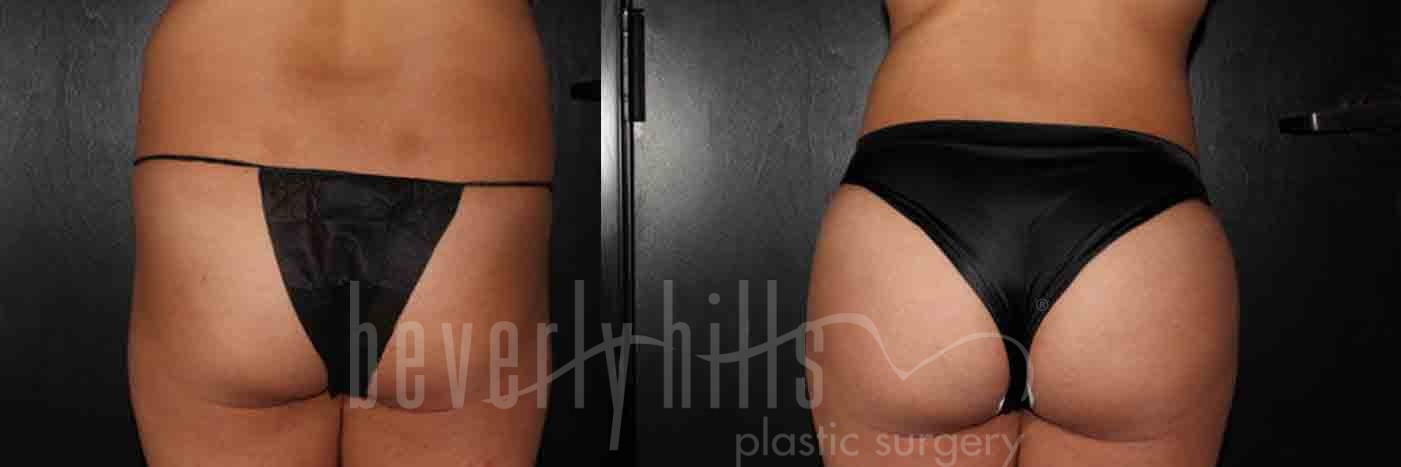 Brazilian Butt Lift Patient 19 Before & After
