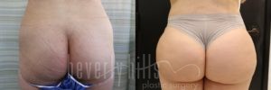 Brazilian Butt Lift Patient 21 Before & After - Thumbnail