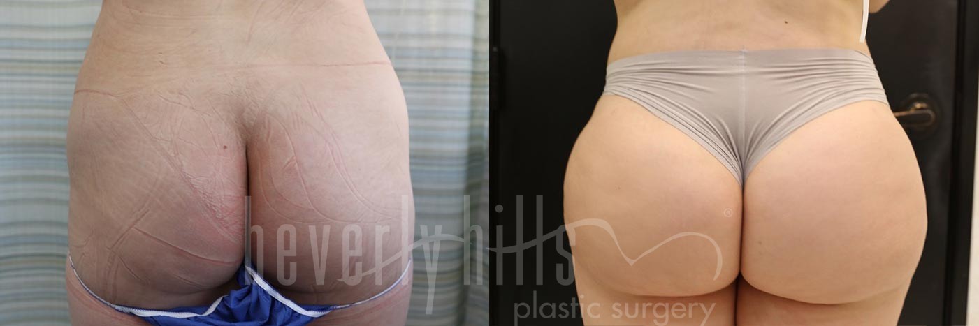 Brazilian Butt Lift Patient 21 Before & After