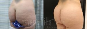 Brazilian Butt Lift Patient 21 Before & After - Thumbnail