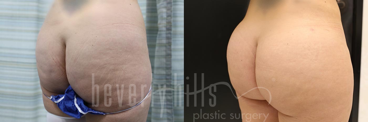 Brazilian Butt Lift Patient 21 Before & After