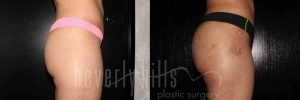 Brazilian Butt Lift Patient 20 Before & After - Thumbnail