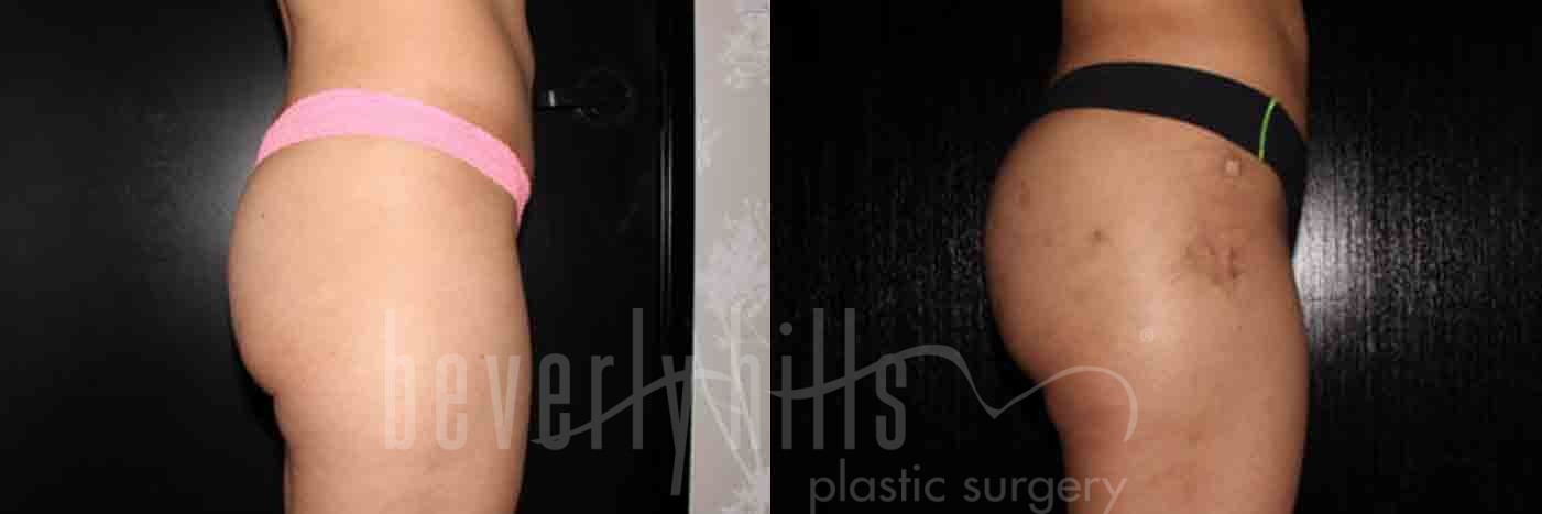 Brazilian Butt Lift Patient 20 Before & After