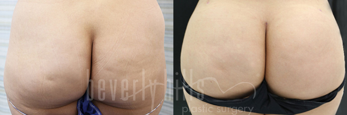 Brazilian Butt Lift Patient 30 Before & After