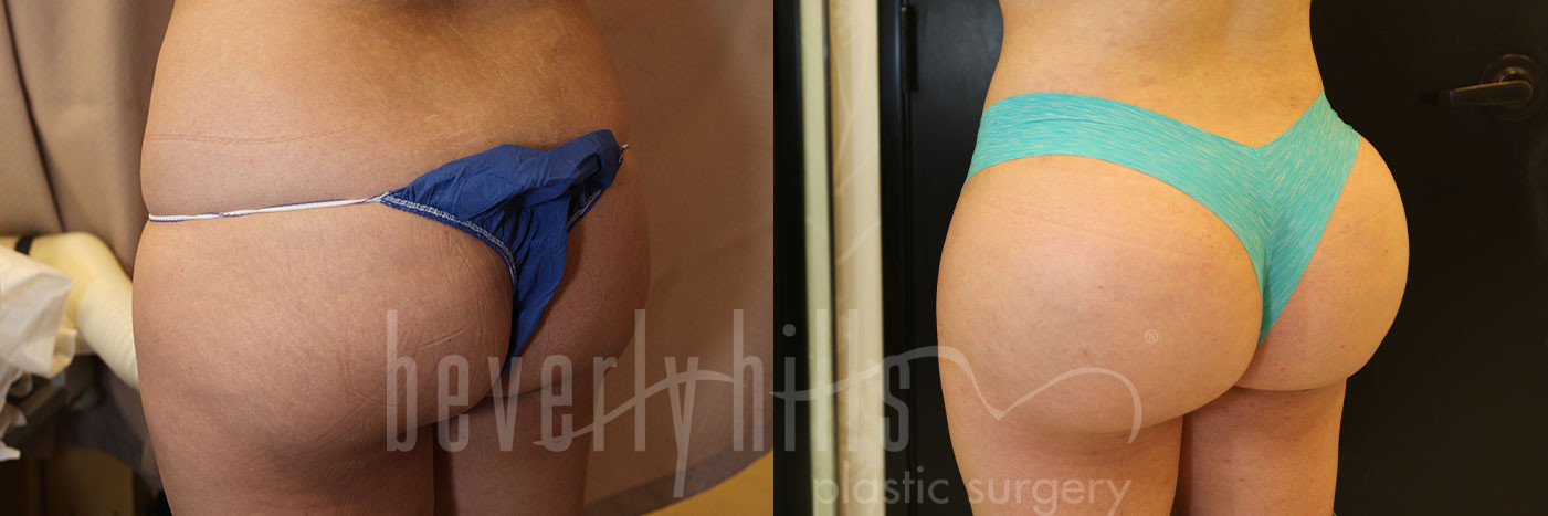 Brazilian Butt Lift Patient 24 Before & After