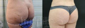 Brazilian Butt Lift Patient 26 Before & After - Thumbnail